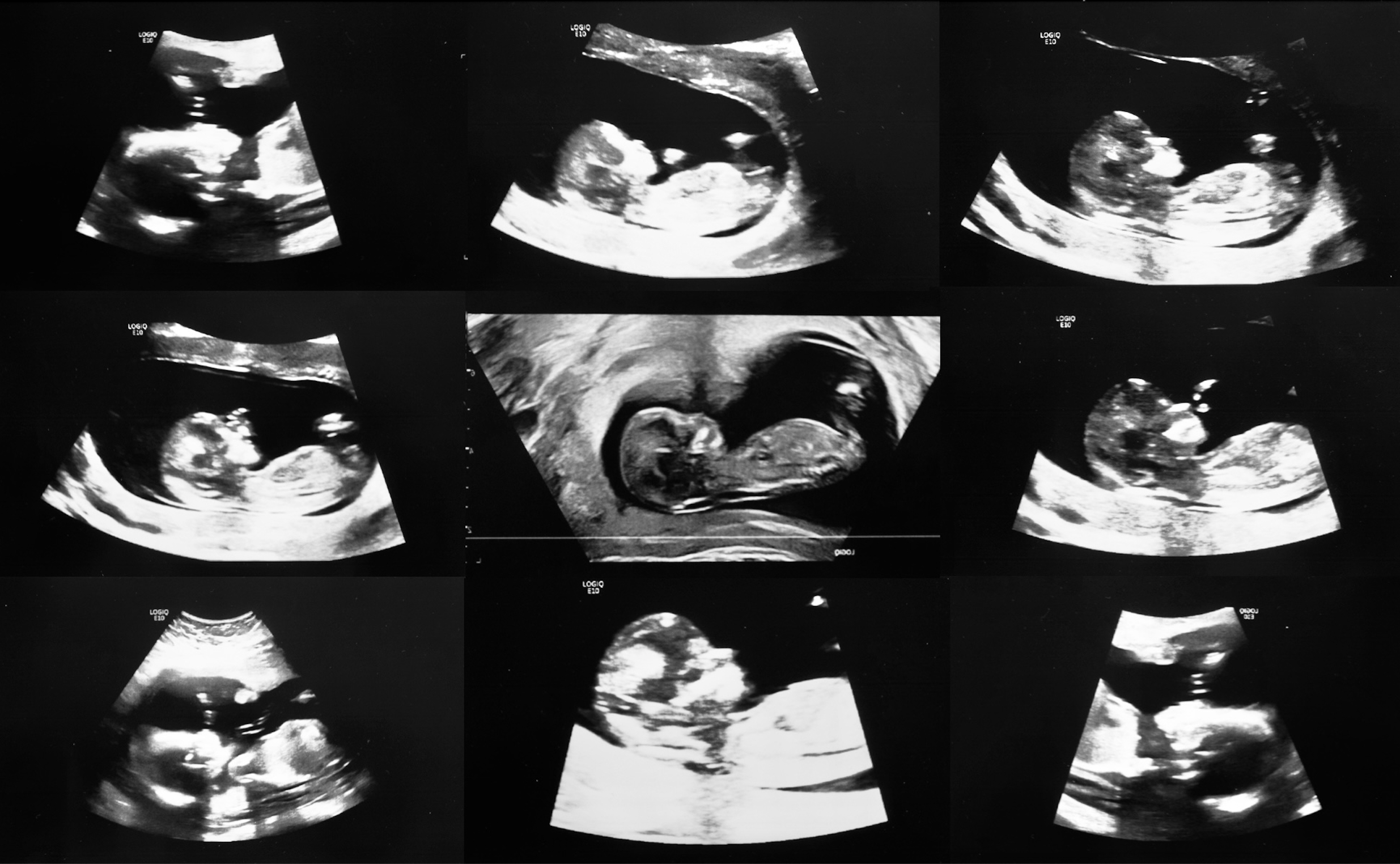 A black and white composite of ultrasound scans, arranged in a grid format. Each frame captures a fetus at various angles and different stages of gestation.