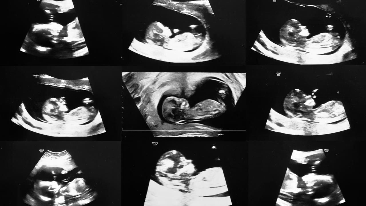 A black and white composite of ultrasound scans, arranged in a grid format. Each frame captures a fetus at various angles and different stages of gestation. 